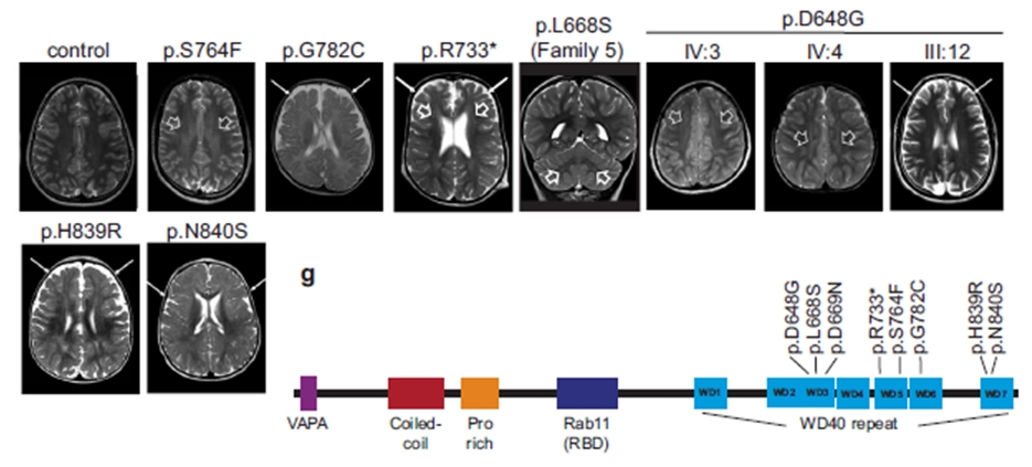 그림. 소뇌증, 늘어난 뇌혈관주위공간 등의 섬모질환 범위의 증상을 보이는 환자에서 WDR44 유전자의 WD motif에 유전적 변이가 있는 것을 확인함.