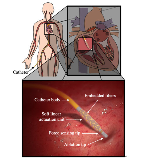 ▲ 초소형 유연 구동기 및 촉각 센서가 장착된 카테터 시술 모식도