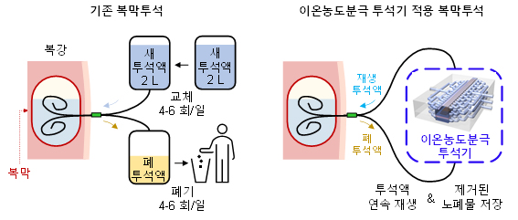 ▲ 그림1. (좌) 기존 복막투석법 (우) 이온농도분극 투석기가 적용된 투석액 연속 재생형 복막투석법 개요